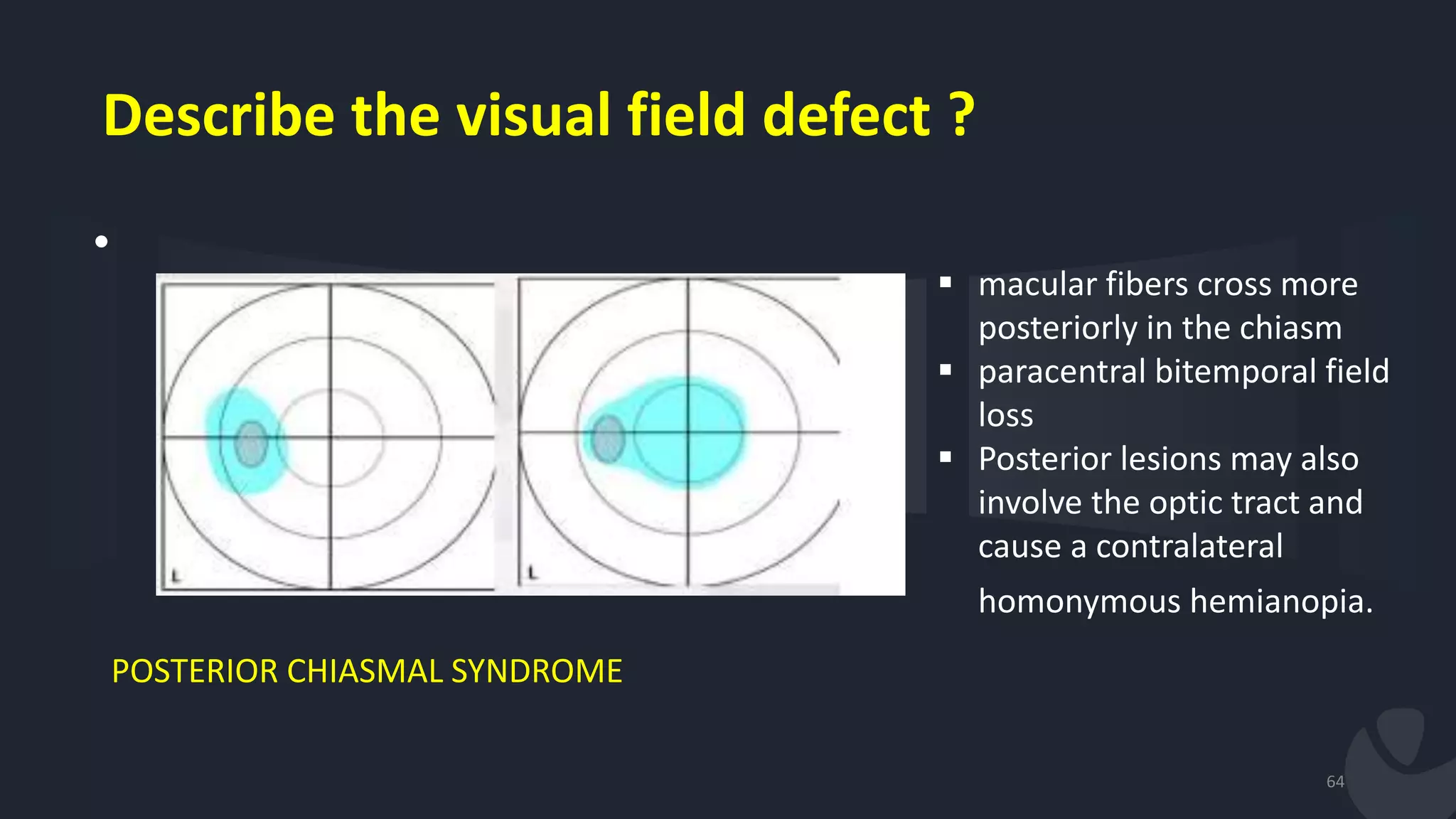 Describe the visual field defect ?
•
64
POSTERIOR CHIASMAL SYNDROME
 macular fibers cross more
posteriorly in the chiasm
 paracentral bitemporal field
loss
 Posterior lesions may also
involve the optic tract and
cause a contralateral
homonymous hemianopia.
 