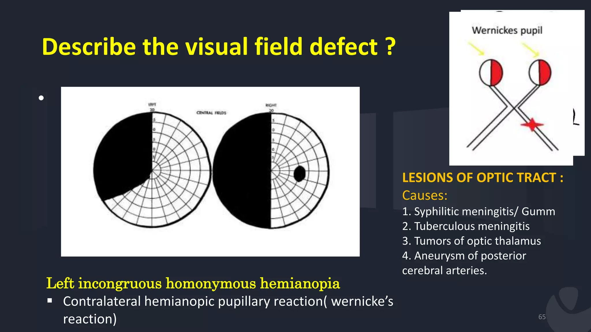 Describe the visual field defect ?
•
65
Left incongruous homonymous hemianopia
 Contralateral hemianopic pupillary reaction( wernicke’s
reaction)
LESIONS OF OPTIC TRACT :
Causes:
1. Syphilitic meningitis/ Gumm
2. Tuberculous meningitis
3. Tumors of optic thalamus
4. Aneurysm of posterior
cerebral arteries.
 