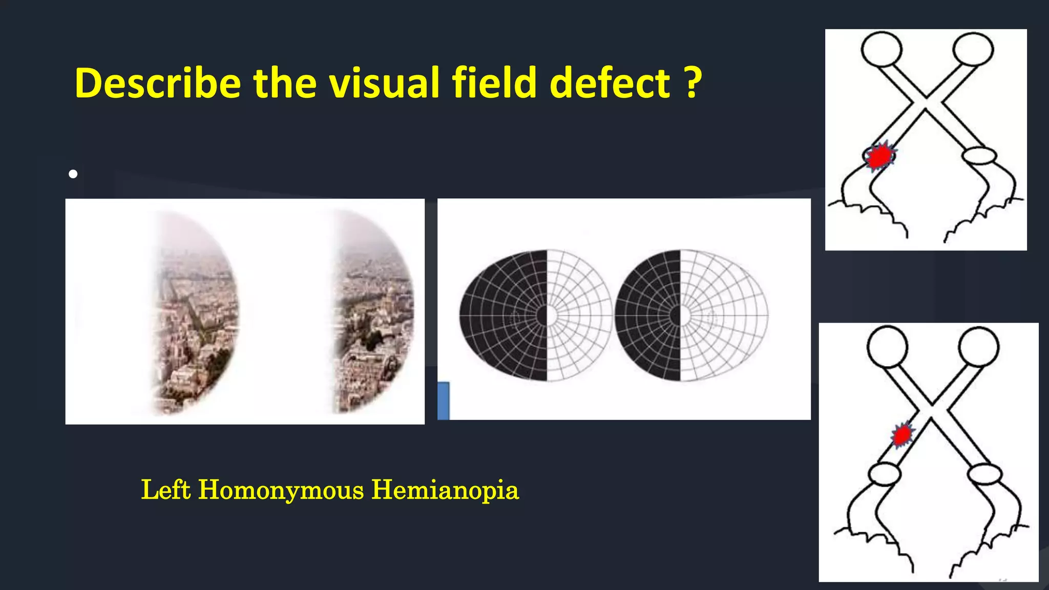 Describe the visual field defect ?
•
66
Left Homonymous Hemianopia
 