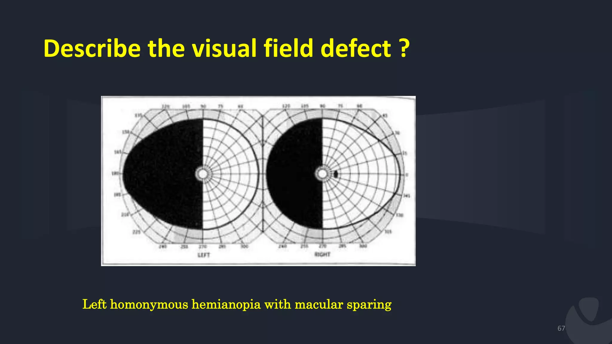 Describe the visual field defect ?
67
Left homonymous hemianopia with macular sparing
 