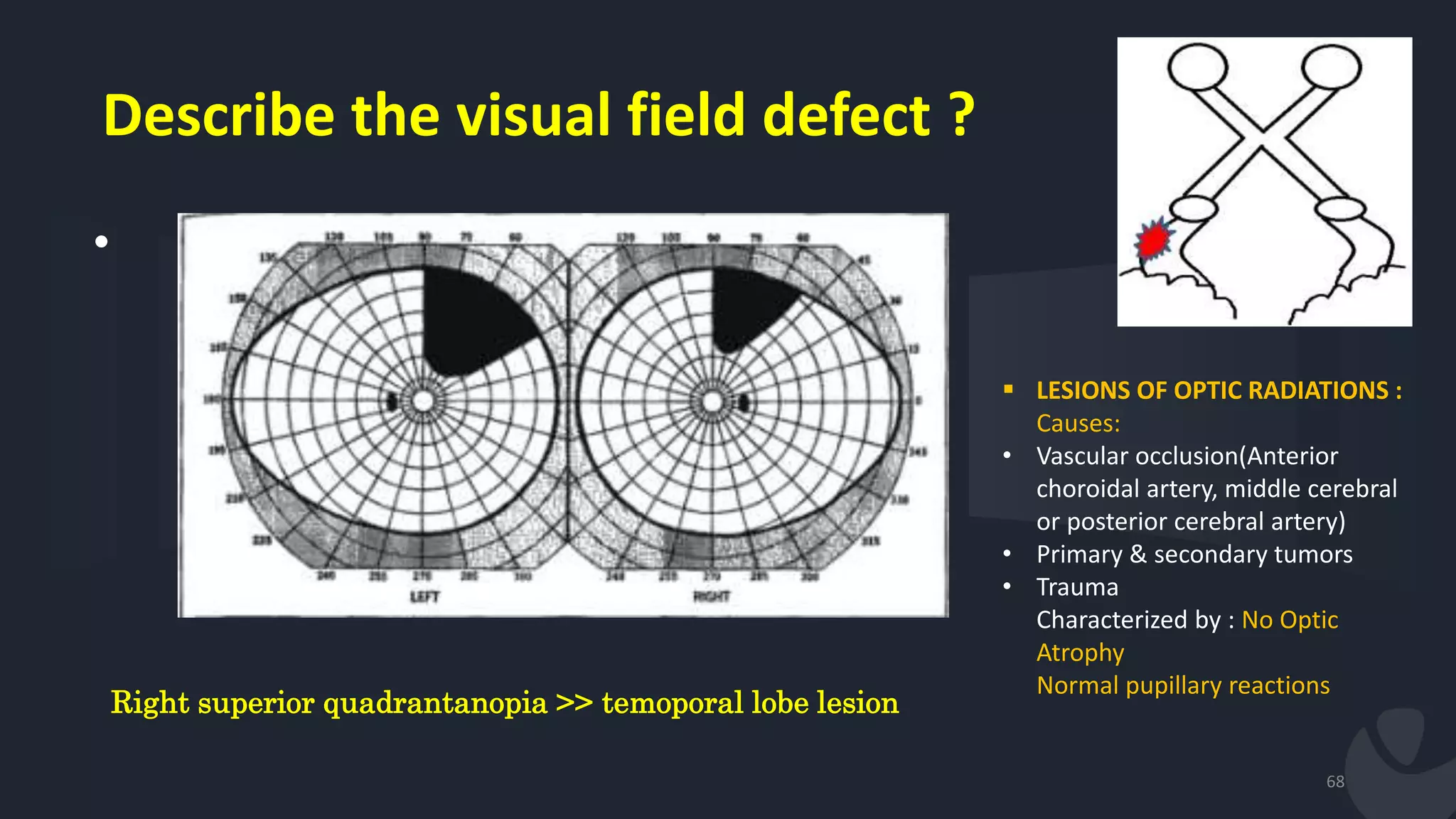 Describe the visual field defect ?
•
68
Right superior quadrantanopia >> temoporal lobe lesion
 LESIONS OF OPTIC RADIATIONS :
Causes:
• Vascular occlusion(Anterior
choroidal artery, middle cerebral
or posterior cerebral artery)
• Primary & secondary tumors
• Trauma
Characterized by : No Optic
Atrophy
Normal pupillary reactions
 