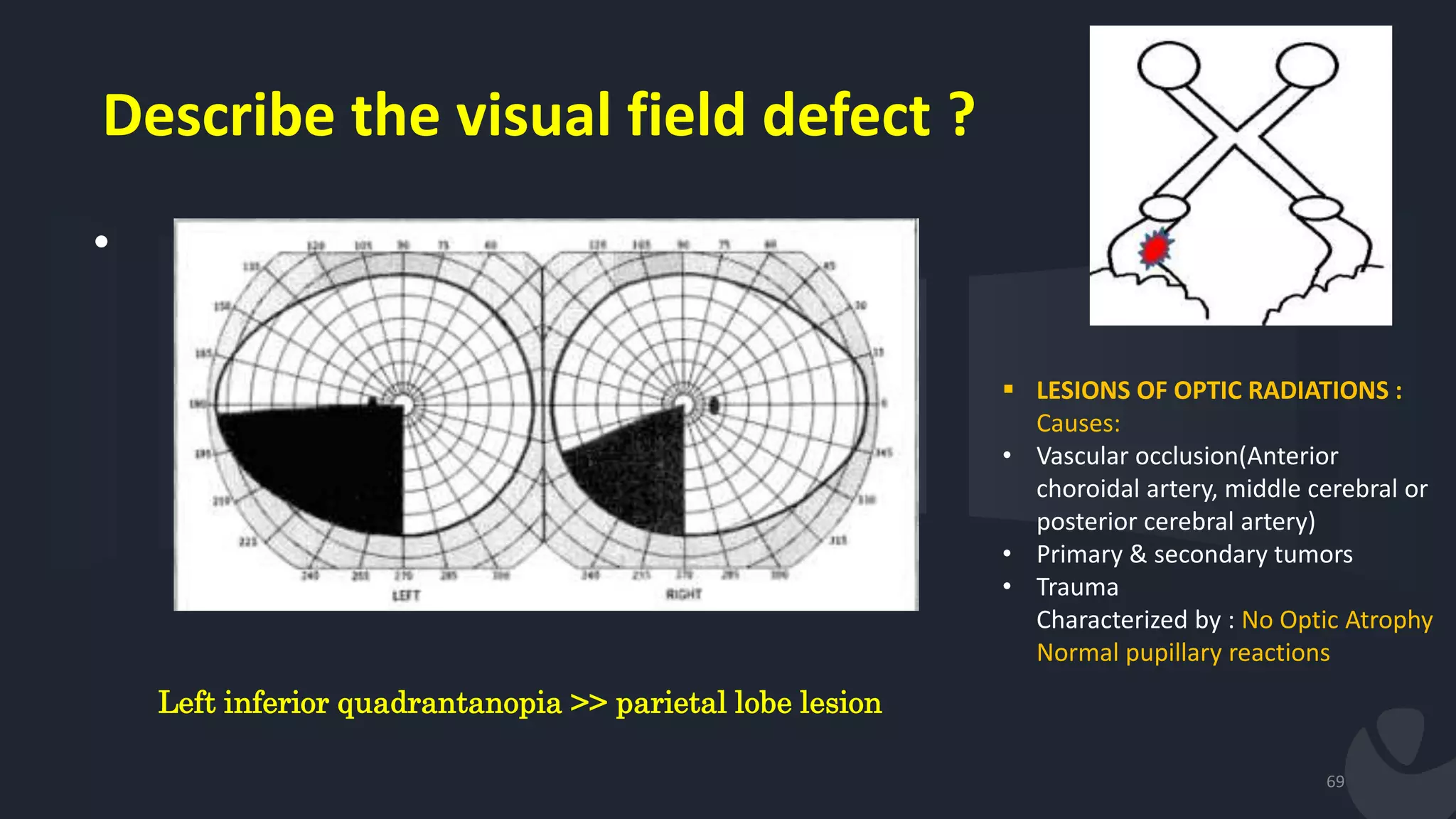 Describe the visual field defect ?
•
69
Left inferior quadrantanopia >> parietal lobe lesion
 LESIONS OF OPTIC RADIATIONS :
Causes:
• Vascular occlusion(Anterior
choroidal artery, middle cerebral or
posterior cerebral artery)
• Primary & secondary tumors
• Trauma
Characterized by : No Optic Atrophy
Normal pupillary reactions
 