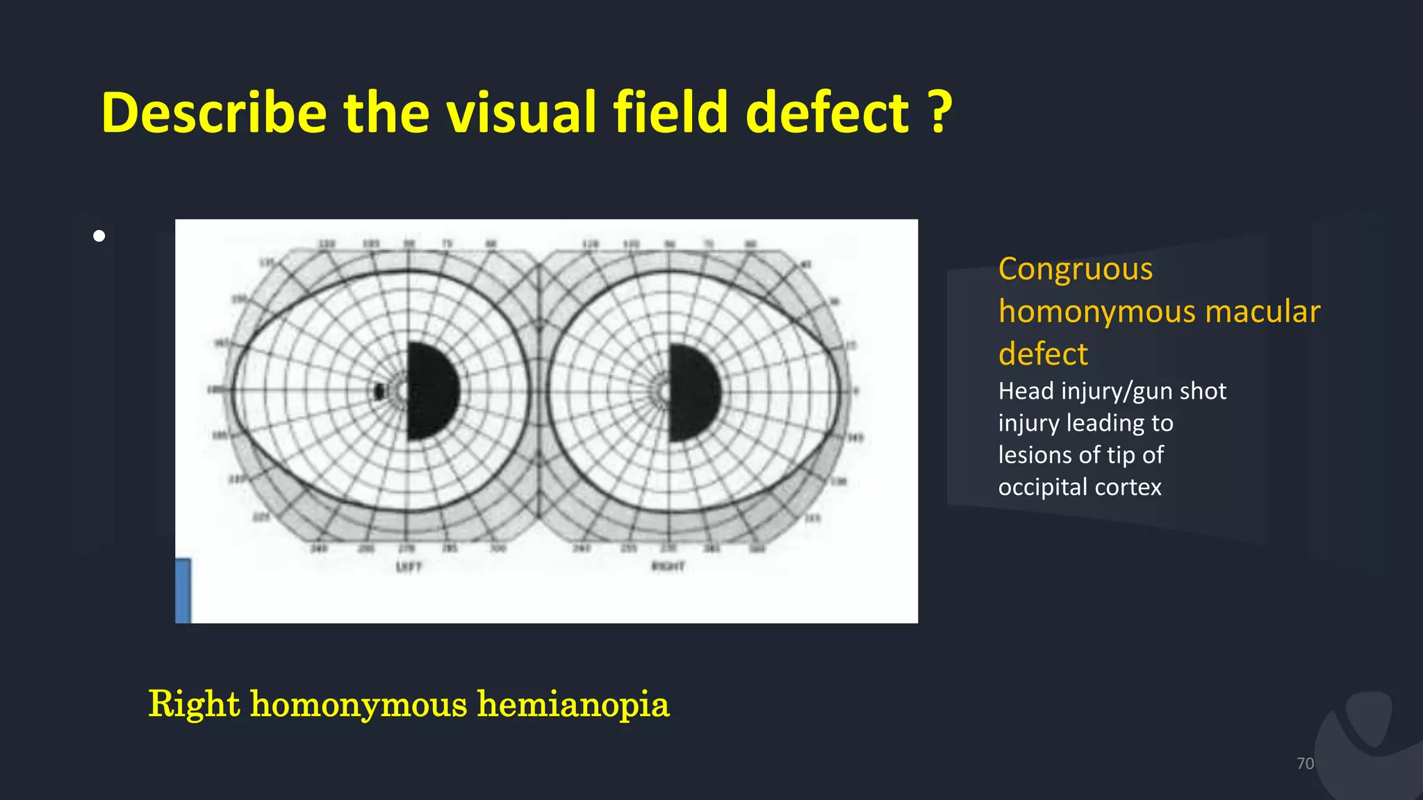Describe the visual field defect ?
•
70
Right homonymous hemianopia
Congruous
homonymous macular
defect
Head injury/gun shot
injury leading to
lesions of tip of
occipital cortex
 