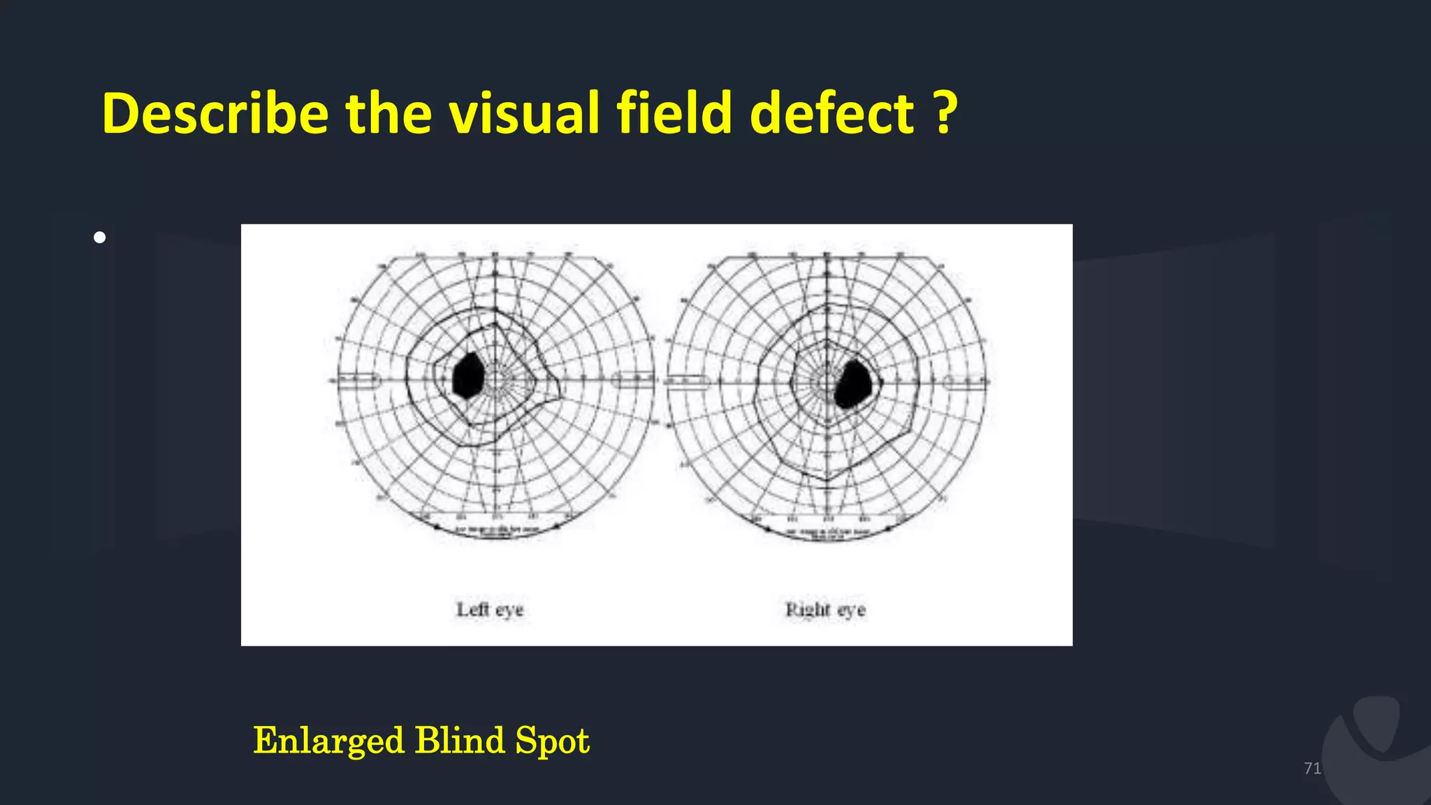 Describe the visual field defect ?
•
71
Enlarged Blind Spot
 