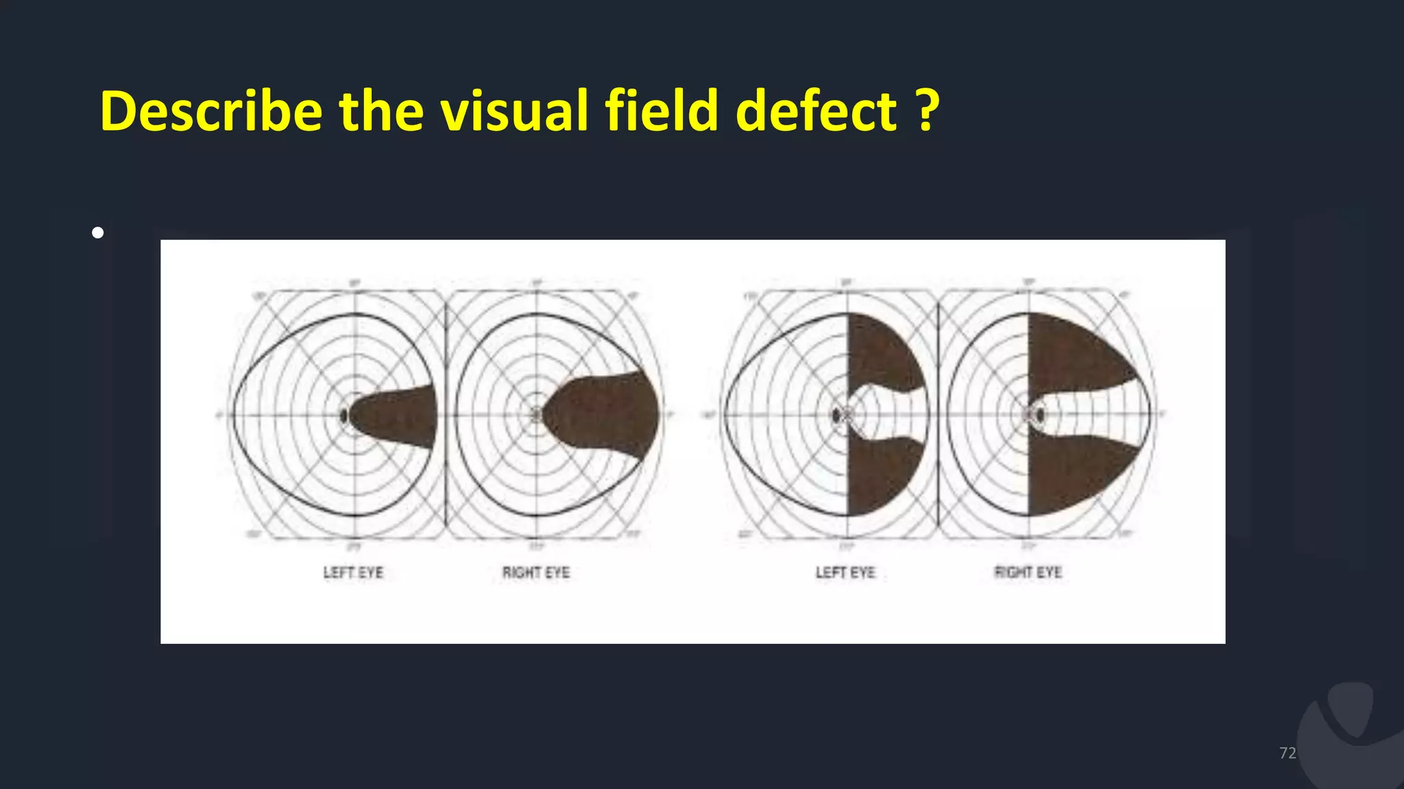 Describe the visual field defect ?
•
72
 