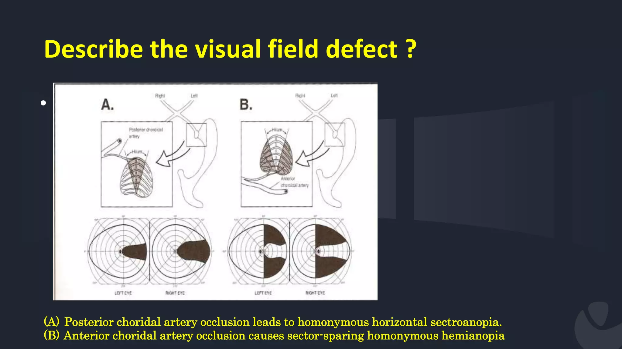 Describe the visual field defect ?
•
(A) Posterior choridal artery occlusion leads to homonymous horizontal sectroanopia.
(B) Anterior choridal artery occlusion causes sector-sparing homonymous hemianopia
 