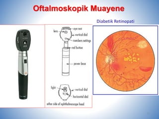 Diabetik Retinopati
11
Oftalmoskopik Muayene
 