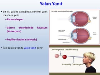 Yakın Yanıt
• Bir kişi yakına baktığında 3 önemli yanıt
meydana gelir:
–Akomodasyon
–Görme eksenlerinde kavuşum
(konverjans)
–Pupiller daralma (miyozis)
• İşte bu üçlü yanıta yakın yanıt denir
33
 