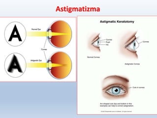 Astigmatizma
41
 