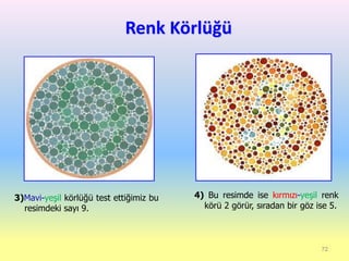 Renk Körlüğü
72
3)Mavi-yeşil körlüğü test ettiğimiz bu
resimdeki sayı 9.
4) Bu resimde ise kırmızı-yeşil renk
körü 2 görür, sıradan bir göz ise 5.
 