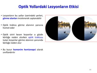 Optik Yollardaki Lezyonların Etkisi
• Lezyonların bu yollar üzerindeki yerleri,
görme alanları incelenerek saptanabilir
• Optik traktus görme alanının yarısına
hizmet eder
• Optik siniri kesen lezyonlar o gözde
körlüğe neden olurken optik traktusu
tutan lezyonlar görme alanının yarısında
körlüğe neden olur
• Bu kusur homonim hemianopsi olarak
sınıflandırılır
88
 