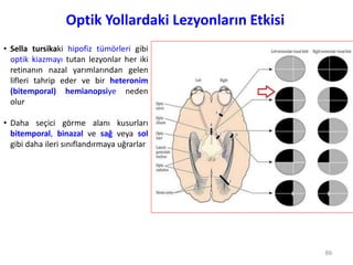 Optik Yollardaki Lezyonların Etkisi
• Sella tursikaki hipofiz tümörleri gibi
optik kiazmayı tutan lezyonlar her iki
retinanın nazal yarımlarından gelen
lifleri tahrip eder ve bir heteronim
(bitemporal) hemianopsiye neden
olur
• Daha seçici görme alanı kusurları
bitemporal, binazal ve sağ veya sol
gibi daha ileri sınıflandırmaya uğrarlar
89
 