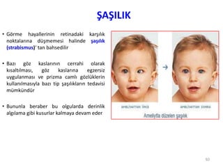 ŞAŞILIK
• Görme hayallerinin retinadaki karşılık
noktalarına düşmemesi halinde şaşılık
(strabismus)‘ tan bahsedilir
• Bazı göz kaslarının cerrahi olarak
kısaltılması, göz kaslarına egzersiz
uygulanması ve prizma camlı gözlüklerin
kullanılmasıyla bazı tip şaşılıkların tedavisi
mümkündür
• Bununla beraber bu olgularda derinlik
algılama gibi kusurlar kalmaya devam eder
93
 