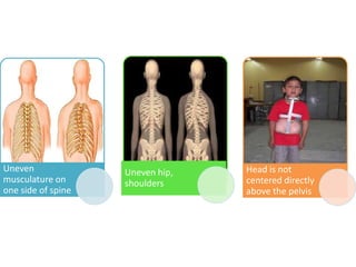 Uneven
musculature on
one side of spine
Uneven hip,
shoulders
Head is not
centered directly
above the pelvis
 