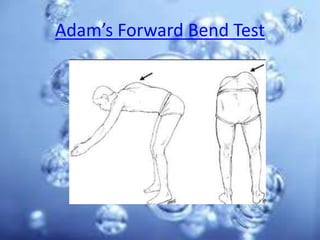 Adam’s Forward Bend Test
 
