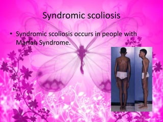 Syndromic scoliosis
• Syndromic scoliosis occurs in people with
Marfan Syndrome.
 