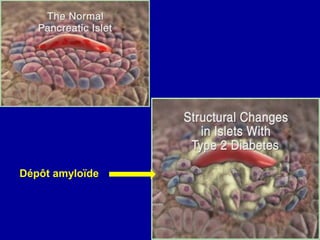 Dépôt amyloïde
 