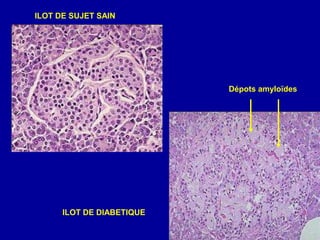 Dépots amyloïdes
ILOT DE DIABETIQUE
ILOT DE SUJET SAIN
 