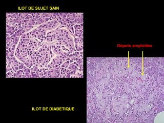 Dépots amyloïdes
ILOT DE DIABETIQUE
ILOT DE SUJET SAIN
 