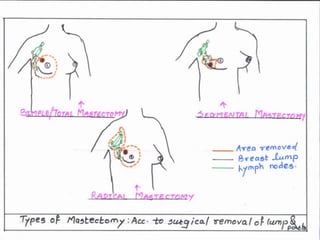 Post Radical PHYSIOTHERAPEUTIC MANAGEMENT POST RADICAL MASTECTOMY.pptx