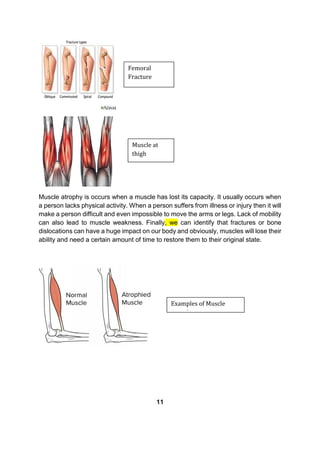 Muscle atrophy is occurs when a muscle has lost its capacity. It usually occurs when
a person lacks physical activity. When a person suffers from illness or injury then it will
make a person difficult and even impossible to move the arms or legs. Lack of mobility
can also lead to muscle weakness. Finally, we can identify that fractures or bone
dislocations can have a huge impact on our body and obviously, muscles will lose their
ability and need a certain amount of time to restore them to their original state.
11
Examples of Muscle
Atrophy
Femoral
Fracture
Muscle at
thigh
 