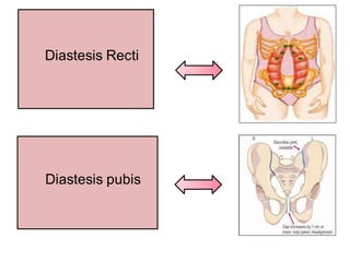 Diastesis pubis
Diastesis Recti
 