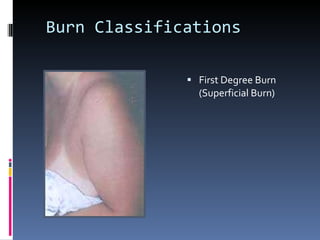 Burn Classifications First Degree Burn (Superficial Burn) 