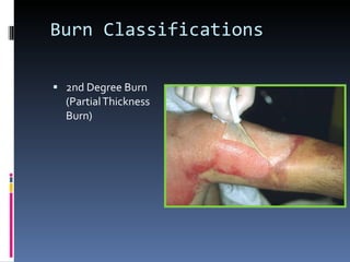 Burn Classifications 2nd Degree Burn (Partial Thickness Burn) 