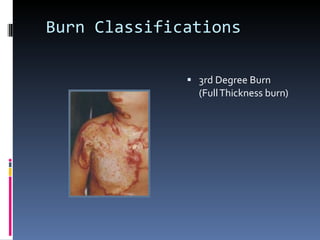 Burn Classifications 3rd Degree Burn (Full Thickness burn) 