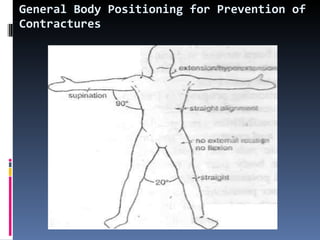 General Body Positioning for Prevention of Contractures 