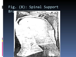 Fig. (8): Spinal Support Brace. 