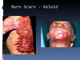 Burn Scars - Keloid 