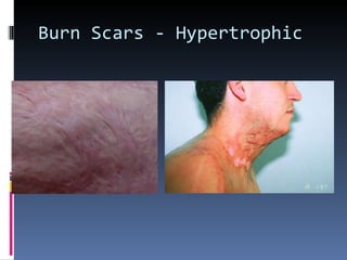 Burn Scars - Hypertrophic 