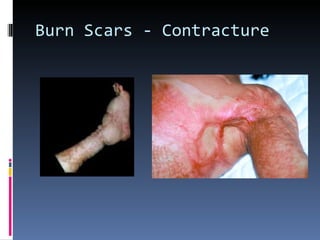 Burn Scars - Contracture 