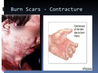 Burn Scars - Contracture 