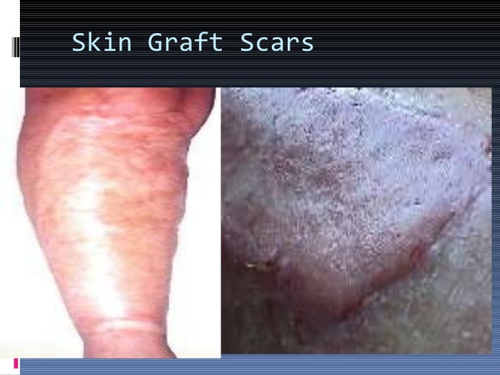 three stages of skin graft healing
