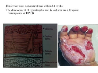 If infection does not occur it heal within 3-4 weeks
The development of hypertrophic and keloid scar are a frequent
consequence of DPTB
 