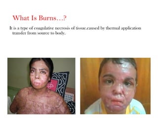 What Is Burns…?
It is a type of coagulative necrosis of tissue.caused by thermal application
transfer from source to body.
 
