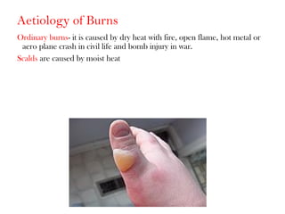 Aetiology of Burns
Ordinary burns- it is caused by dry heat with fire, open flame, hot metal or
aero plane crash in civil life and bomb injury in war.
Scalds are caused by moist heat
 