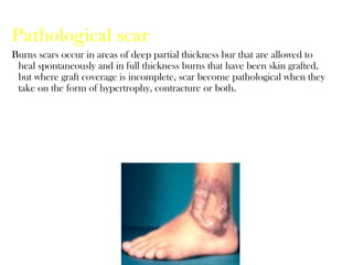 Pathological scar
Burns scars occur in areas of deep partial thickness bur that are allowed to
heal spontaneously and in full thickness burns that have been skin grafted,
but where graft coverage is incomplete, scar become pathological when they
take on the form of hypertrophy, contracture or both.
 