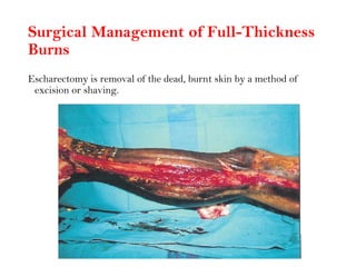 Surgical Management of Full-Thickness
Burns
Escharectomy is removal of the dead, burnt skin by a method of
excision or shaving.
 