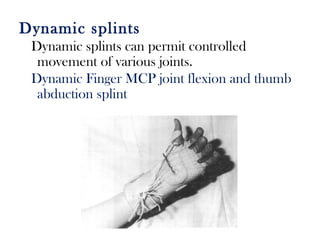 Dynamic splints
Dynamic splints can permit controlled
movement of various joints.
Dynamic Finger MCP joint flexion and thumb
abduction splint
 