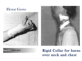 Flexor Grove
Rigid Collar for burns
over neck and chest
 
