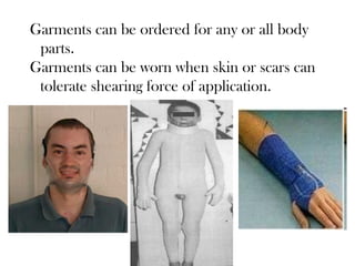 Garments can be ordered for any or all body
parts.
Garments can be worn when skin or scars can
tolerate shearing force of application.
 
