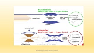 Physiotherapy in Common Vascular Conditions
 