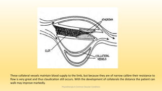 Physiotherapy in Common Vascular Conditions
These collateral vessels maintain blood supply to the limb, but because they are of narrow calibre their resistance to
flow is very great and thus claudication still occurs. With the development of collaterals the distance the patient can
walk may improve markedly.
 