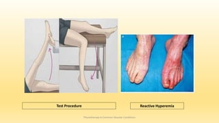 Physiotherapy in Common Vascular Conditions
Reactive Hyperemia
Test Procedure
 