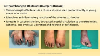 4) Thromboangitis Obliterans (Buerger’s Disease)
• Thromboangitis Obliterans is a chronic disease seen predominantly in young
males who smoke
• It involves an inflammatory reaction of the arteries to nicotine
• It results in vasoconstriction, decreased arterial circulation to the extremities,
ischemia, and eventual ulceration and necrosis of soft tissues.
Physiotherapy in Common Vascular Conditions
 