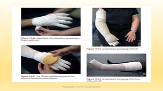 Physiotherapy in Common Vascular Conditions
 