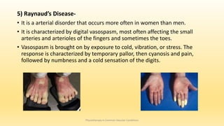 5) Raynaud’s Disease-
• It is a arterial disorder that occurs more often in women than men.
• It is characterized by digital vasospasm, most often affecting the small
arteries and arterioles of the fingers and sometimes the toes.
• Vasospasm is brought on by exposure to cold, vibration, or stress. The
response is characterized by temporary pallor, then cyanosis and pain,
followed by numbness and a cold sensation of the digits.
Physiotherapy in Common Vascular Conditions
 